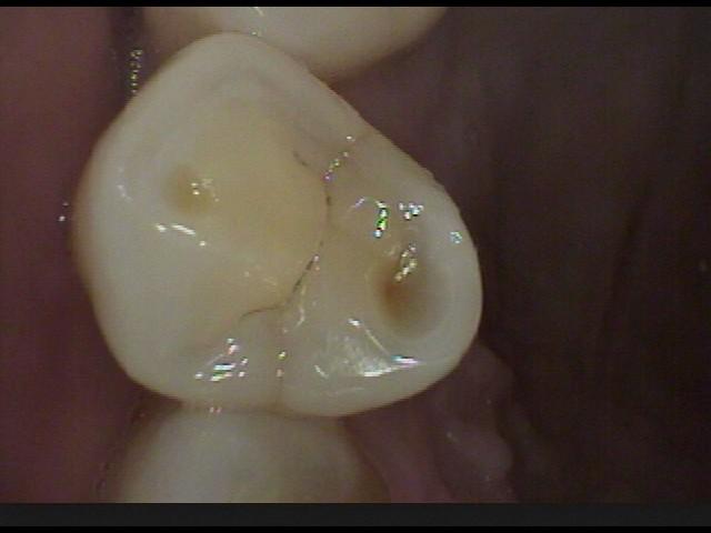酸蝕歯について
