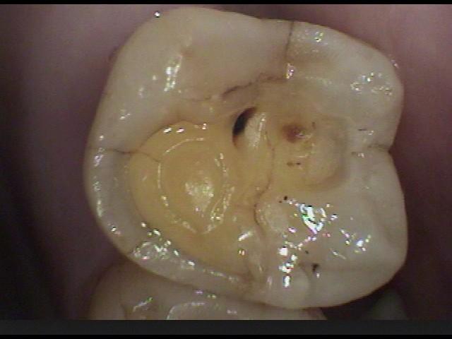 酸蝕歯について