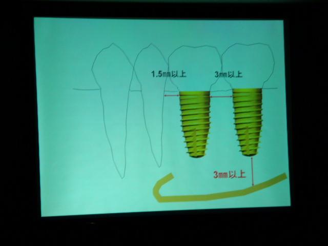 インプラントセミナー