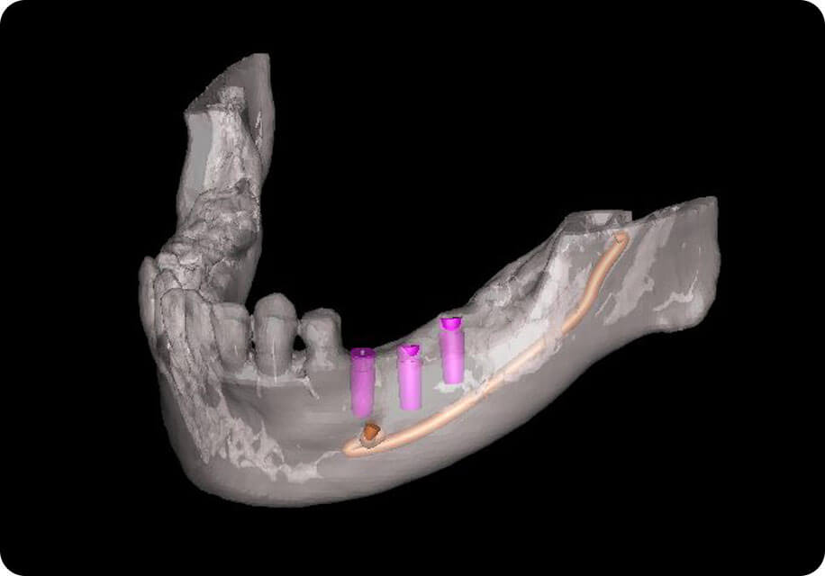 デジタル口腔内3Dスキャナーによる歯型とり・デジタル歯科用CTによる3次元的な骨診断