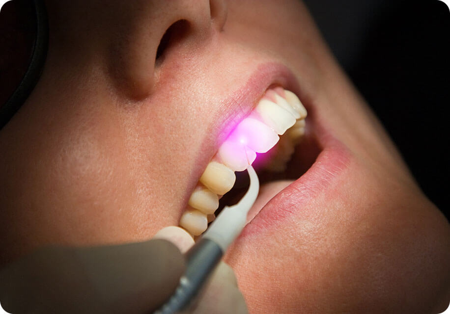 歯を削らないレーザー治療