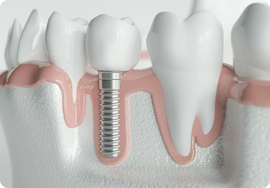 インプラントによる治療｜オーダーメイドな歯科治療と予防重視の浦安 