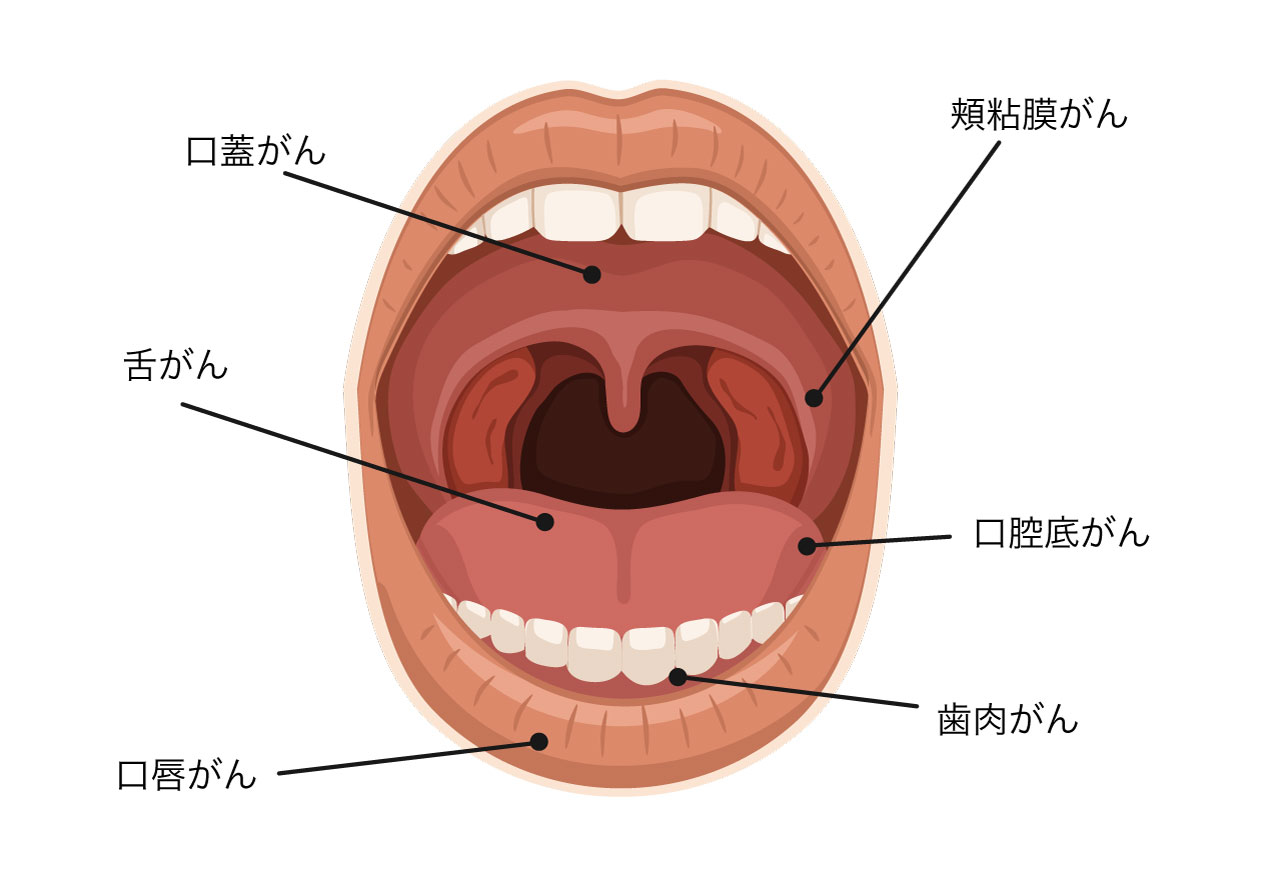 口腔がんの種類 